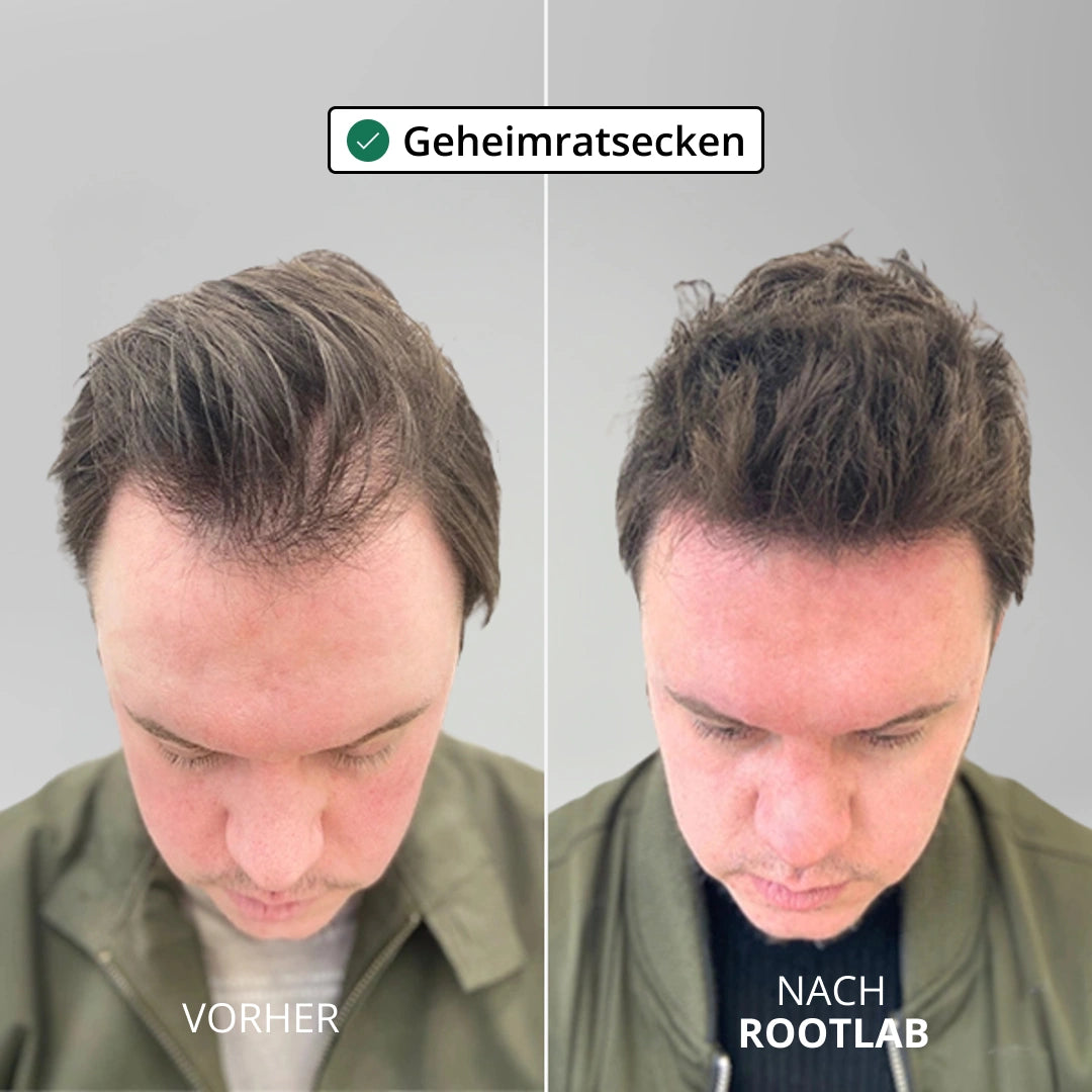 Apex Haarwuchs System korrekt