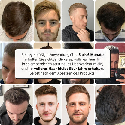 Apex Haarwuchs System korrekt
